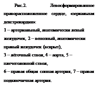 Надпись: Рис.2. Левосформированное праворасположенное сердце, «зеркальная декстрокардия»:
1 – артериальный, анатомически левый желудочек, 2 – венозный, анатомически правый желудочек (вскрыт),
3 – лёгочный ствол, 4 – аорта, 5 – плечеголовной ствол,
6 – правая общая сонная артерия, 7 – правая подключичная артерия.