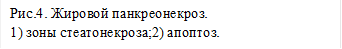Рис.4. Жировой панкреонекроз.
1) зоны стеатонекроза;2) апоптоз.