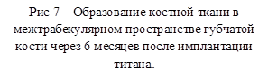 Рис 7 – Образование костной ткани в межтрабекулярном пространстве губчатой кости через 6 месяцев после имплантации титана.
