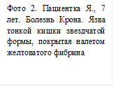 Фото 2. Пациентка Я., 7 лет. Болезнь Крона. Язва тонкой кишки звездчатой формы, покрытая налетом желтоватого фибрина