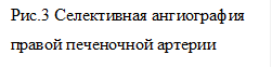 Рис.3 Селективная ангиография правой печеночной артерии