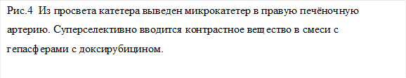 Рис.4 Из просвета катетера выведен микрокатетер в правую печёночную артерию. Суперселективно вводится контрастное вещество в смеси с гепасферами с доксирубицином.