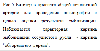 Рис.5 Катетер в просвете общей печеночной артерии для проведения ангиографии с целью оценки результата эмболизации. Наблюдается характерная картина эмболизации сосудистого русла - картина "обгоревшего дерева".