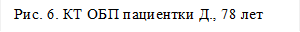 Рис. 6. КТ ОБП пациентки Д., 78 лет
